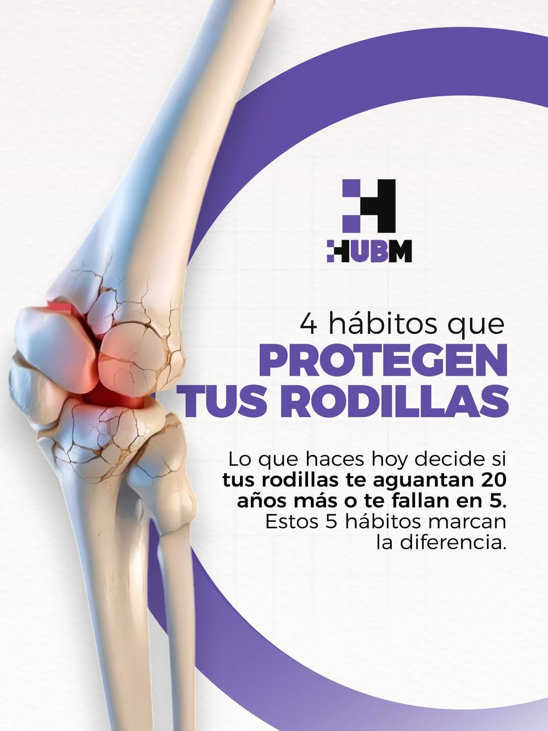 Ilustración anatómica de una rodilla con signos de desgaste articular